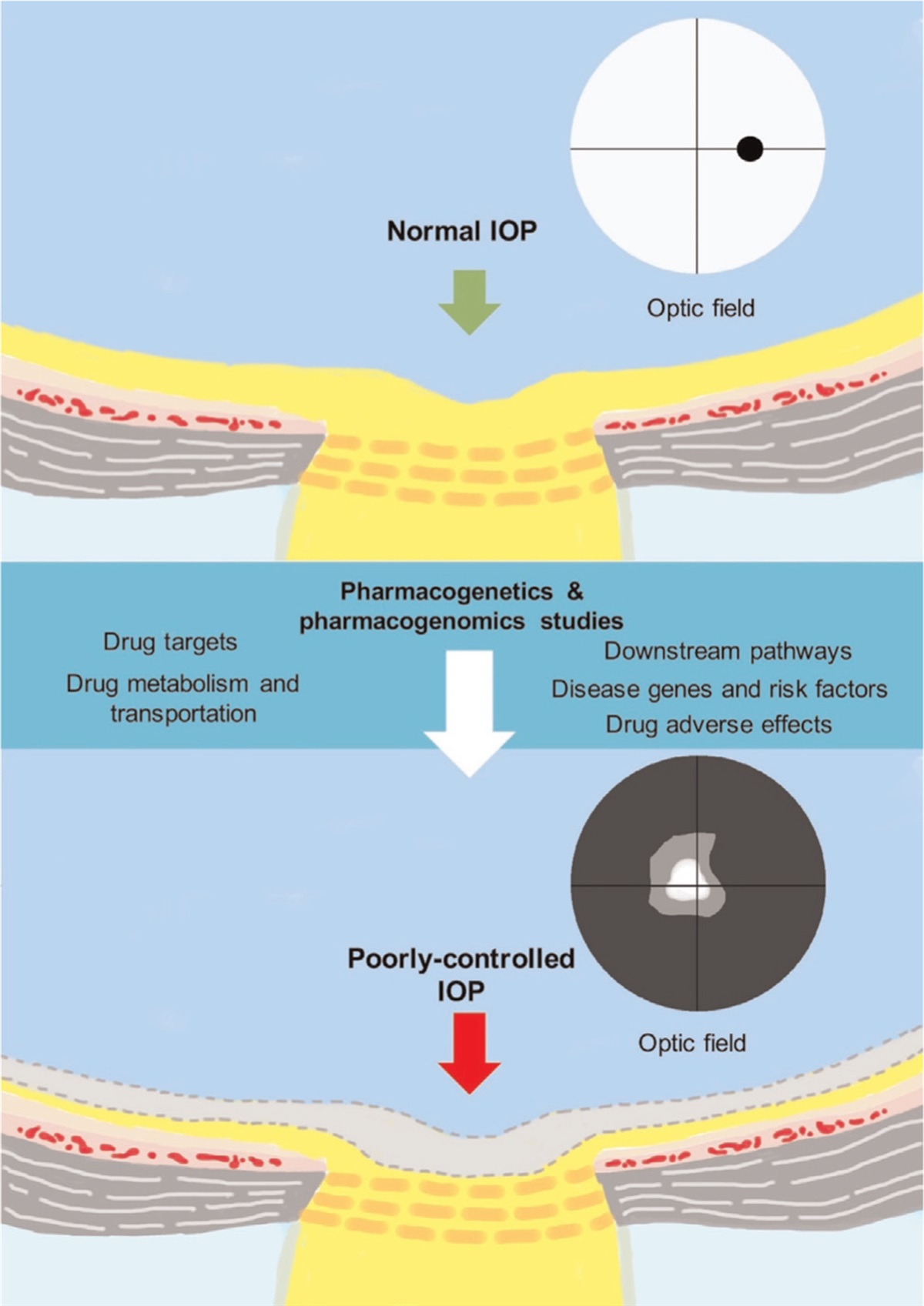 Pharmacogenetics and pharmacogenomics in glaucoma therapeutics: the way to personalized therapy