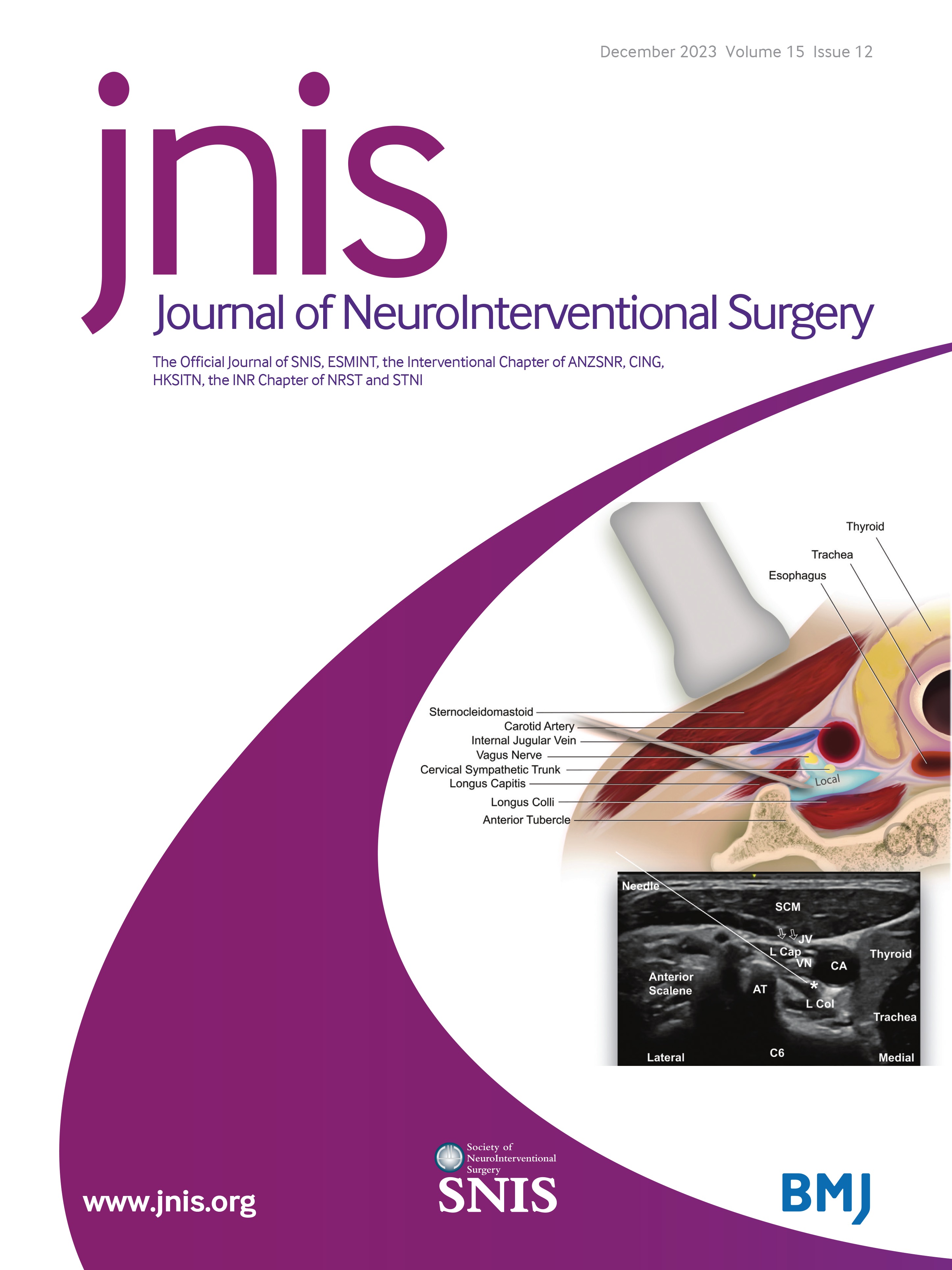 Impact of atrial fibrillation on the treatment effect of bridging thrombolysis in ischemic stroke patients undergoing endovascular thrombectomy: a multicenter international cohort study