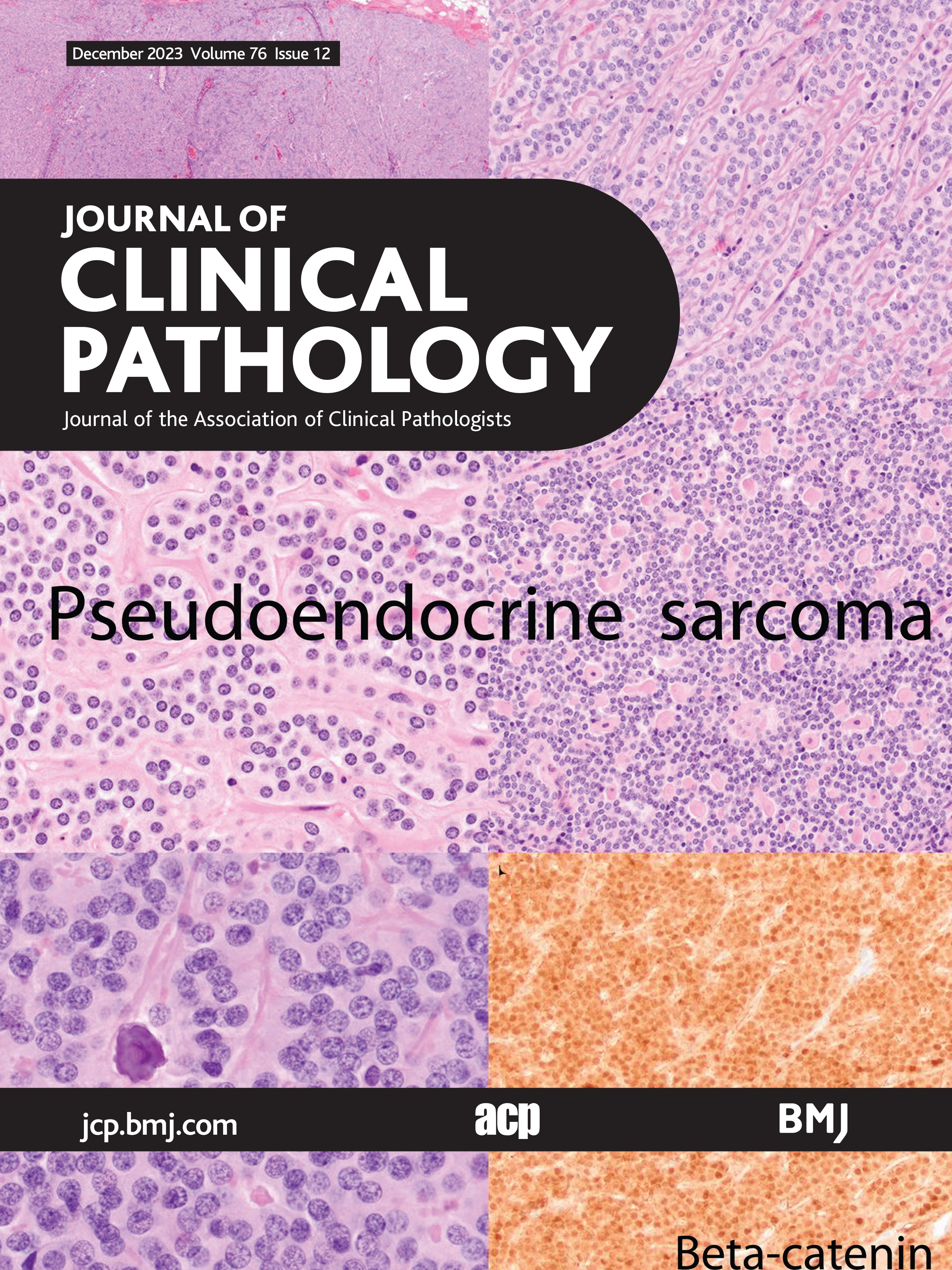 Droplet digital PCR (ddPCR) using FFPE DNA to assess methylation status of MGMT gene among patients with IDH mutant astrocytoma and IDH wild-type glioblastoma