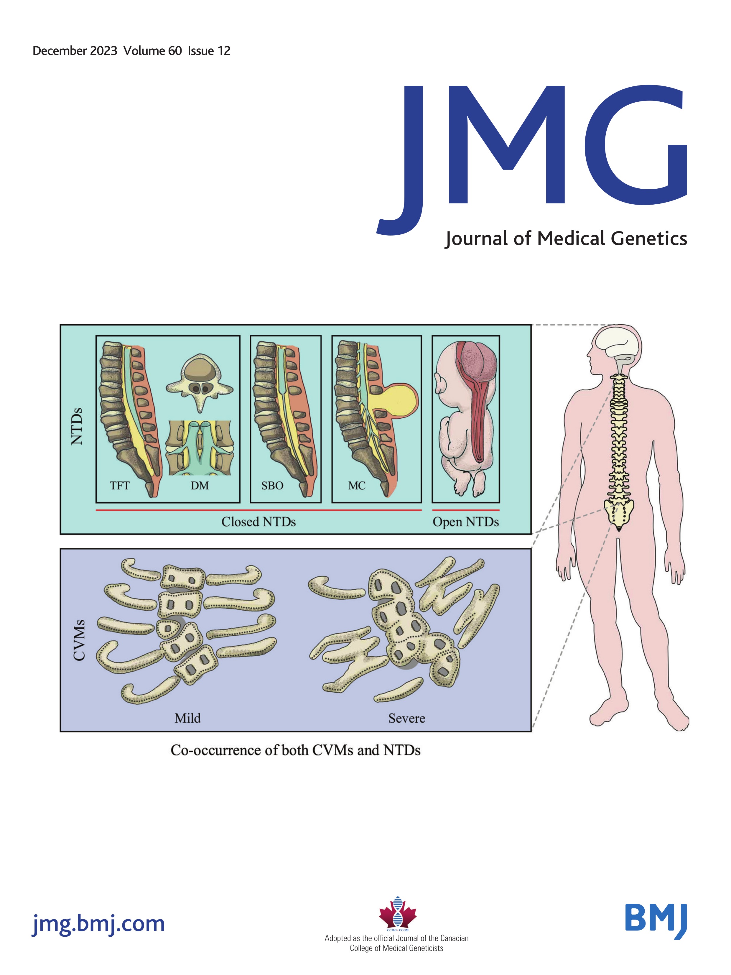 Adaptive nanopore sequencing to determine pathogenicity of BRCA1 exonic duplication