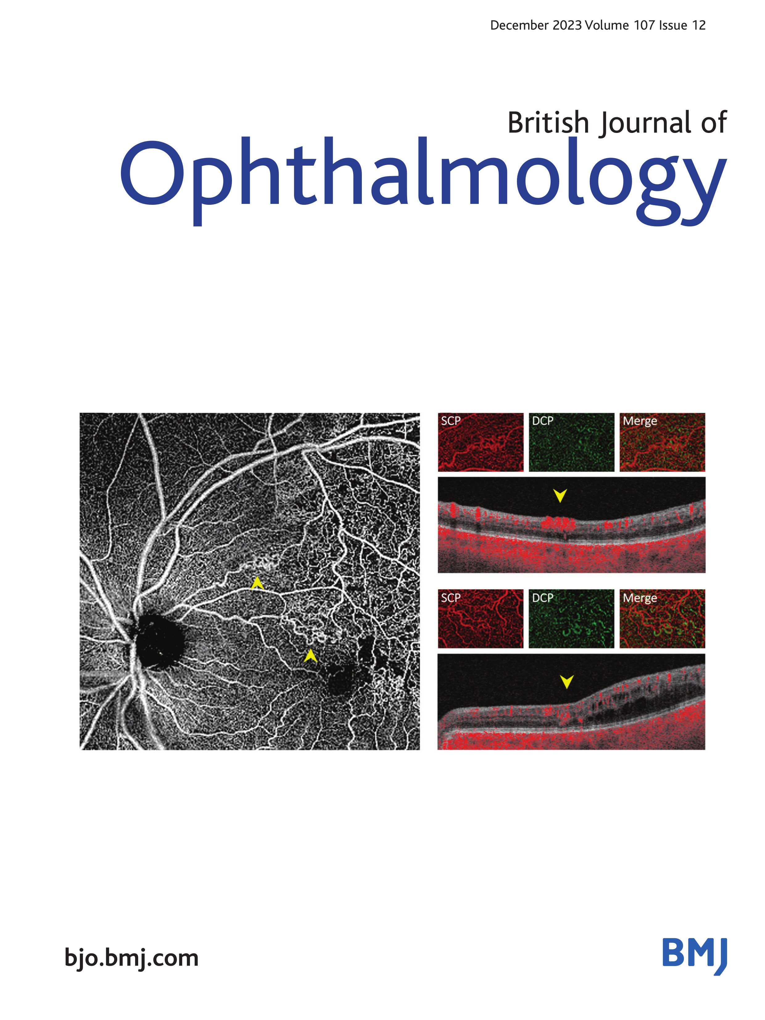 Pupillotonia after endolaser retinopexy during vitrectomy for retinal detachment: a prospective cohort study comparing circumferential and focal retinopexy